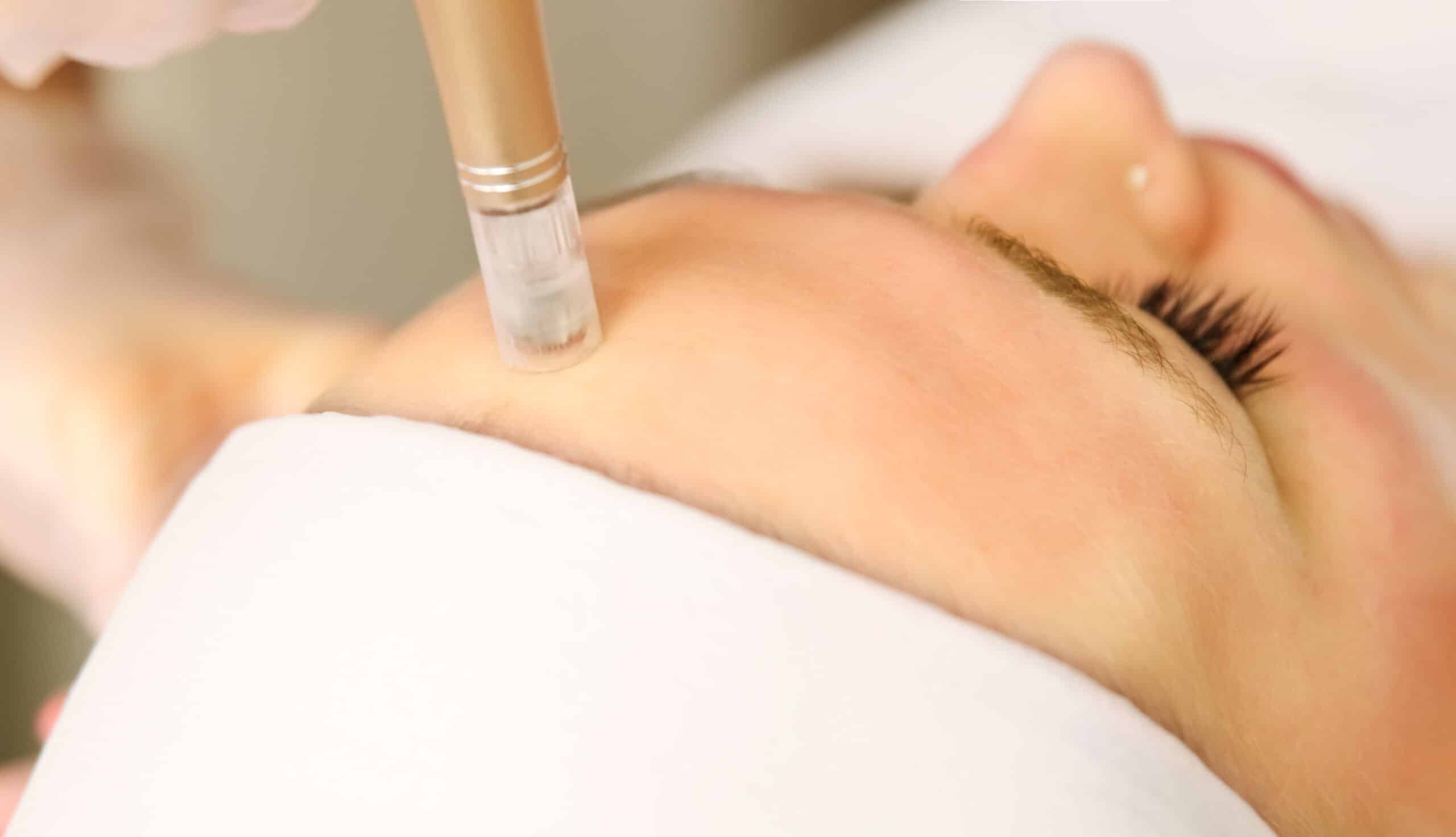 Microneedling-Behandlung an der Gesichtshaut
